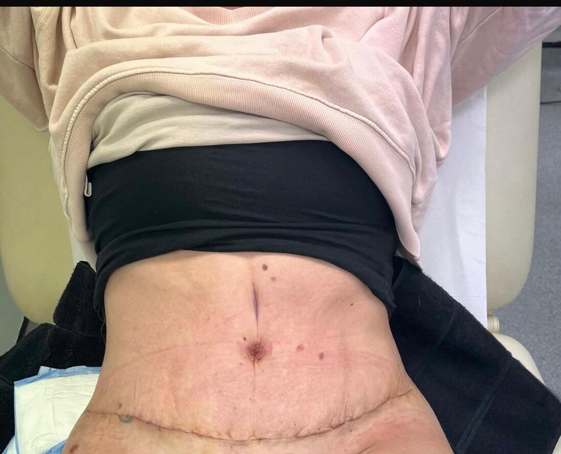 2 weeks post op 1