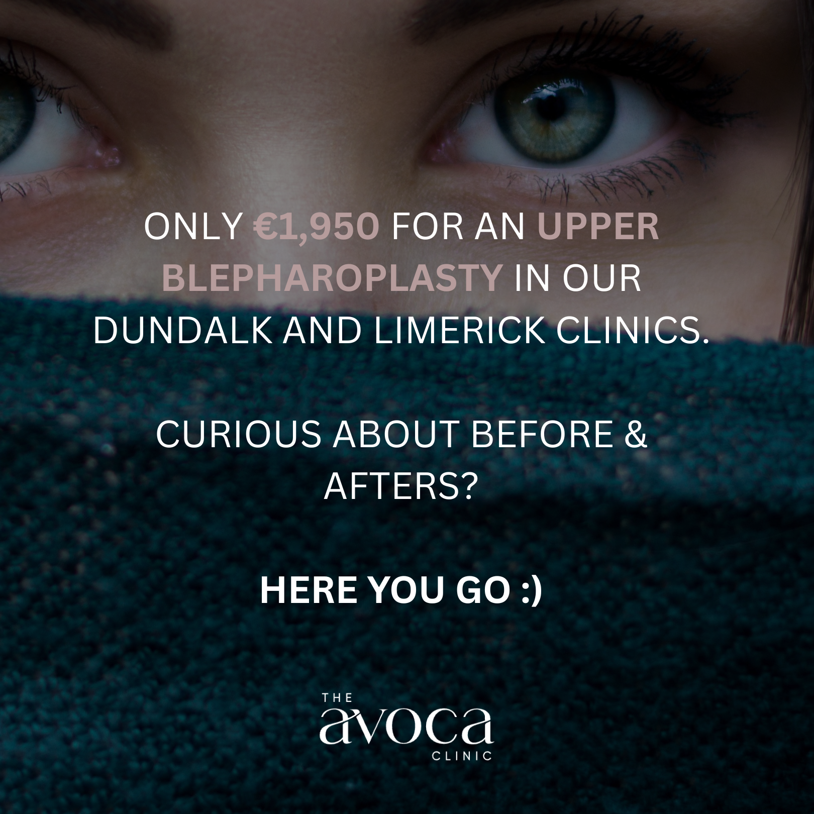 Before After Upper Bleph2 1