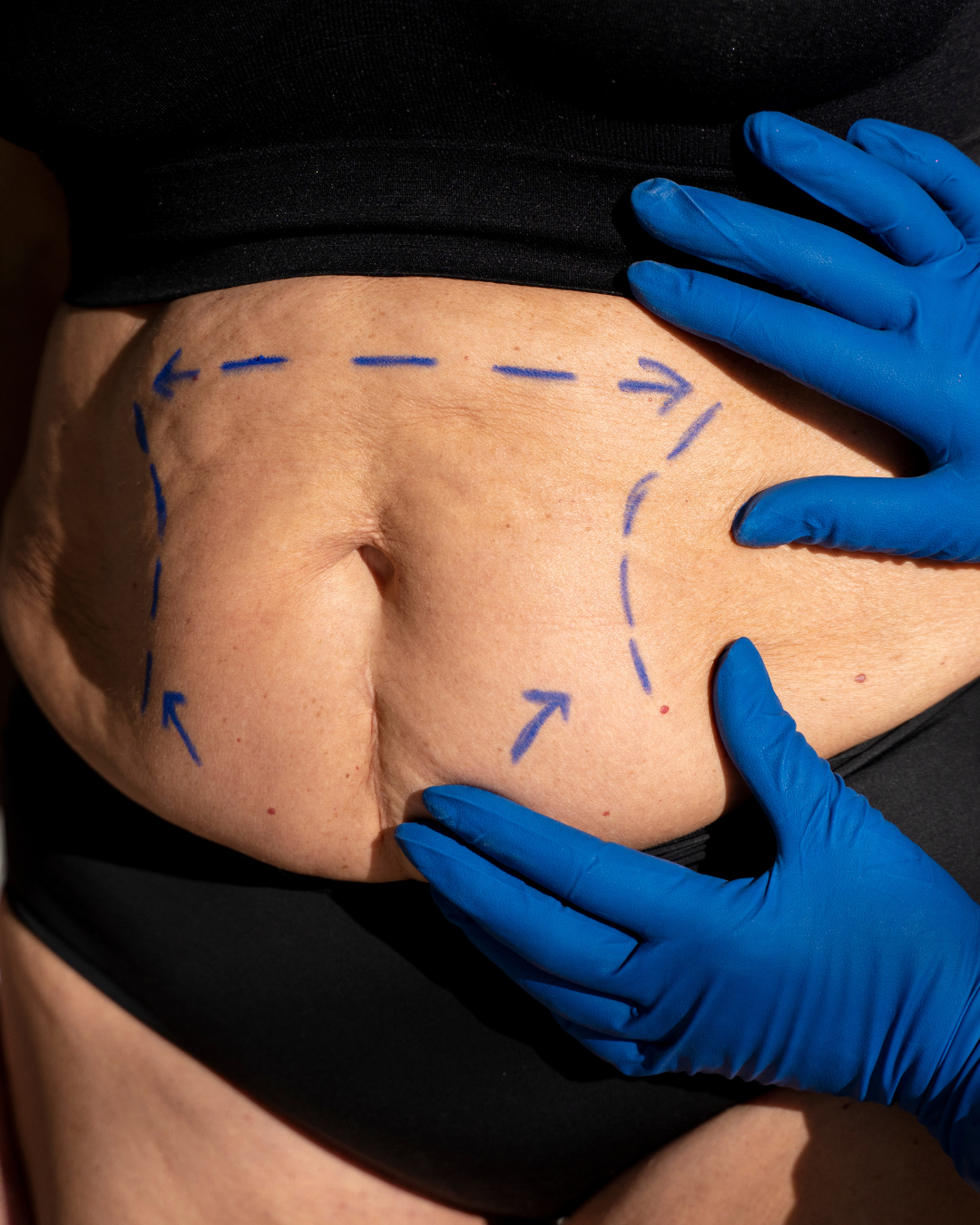 Fat Transfer1