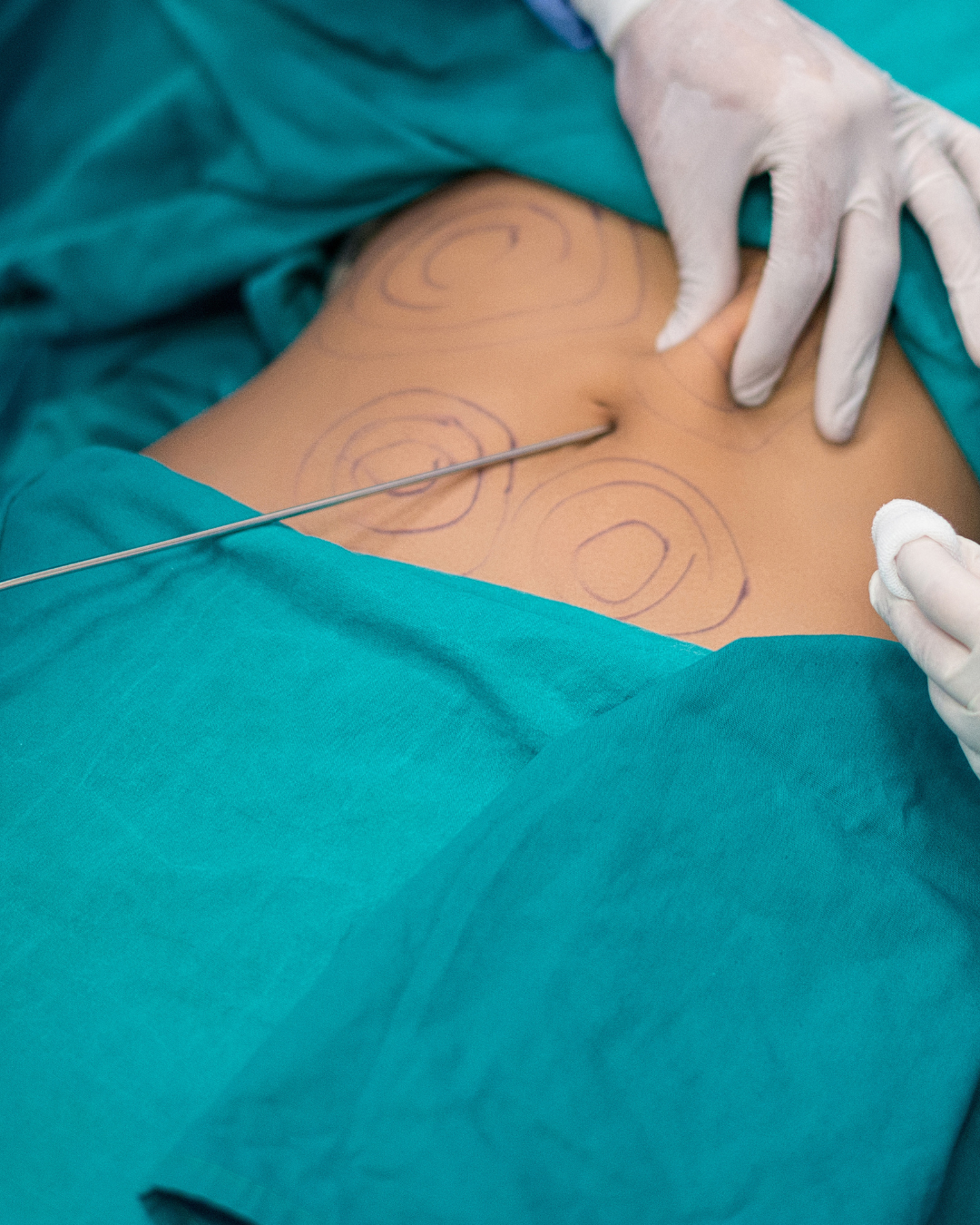 Fat Transfer4