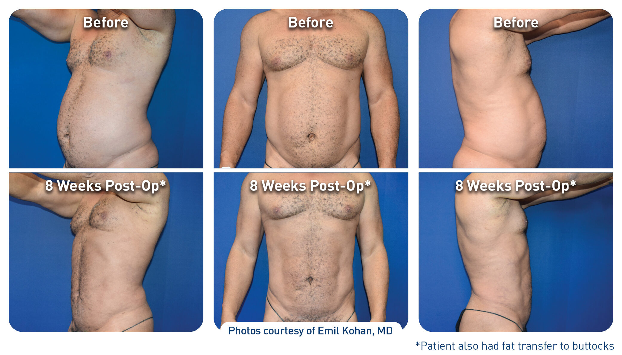 Renuvion Before After Abdominal Case 7 Kohan Photos 300dpi
