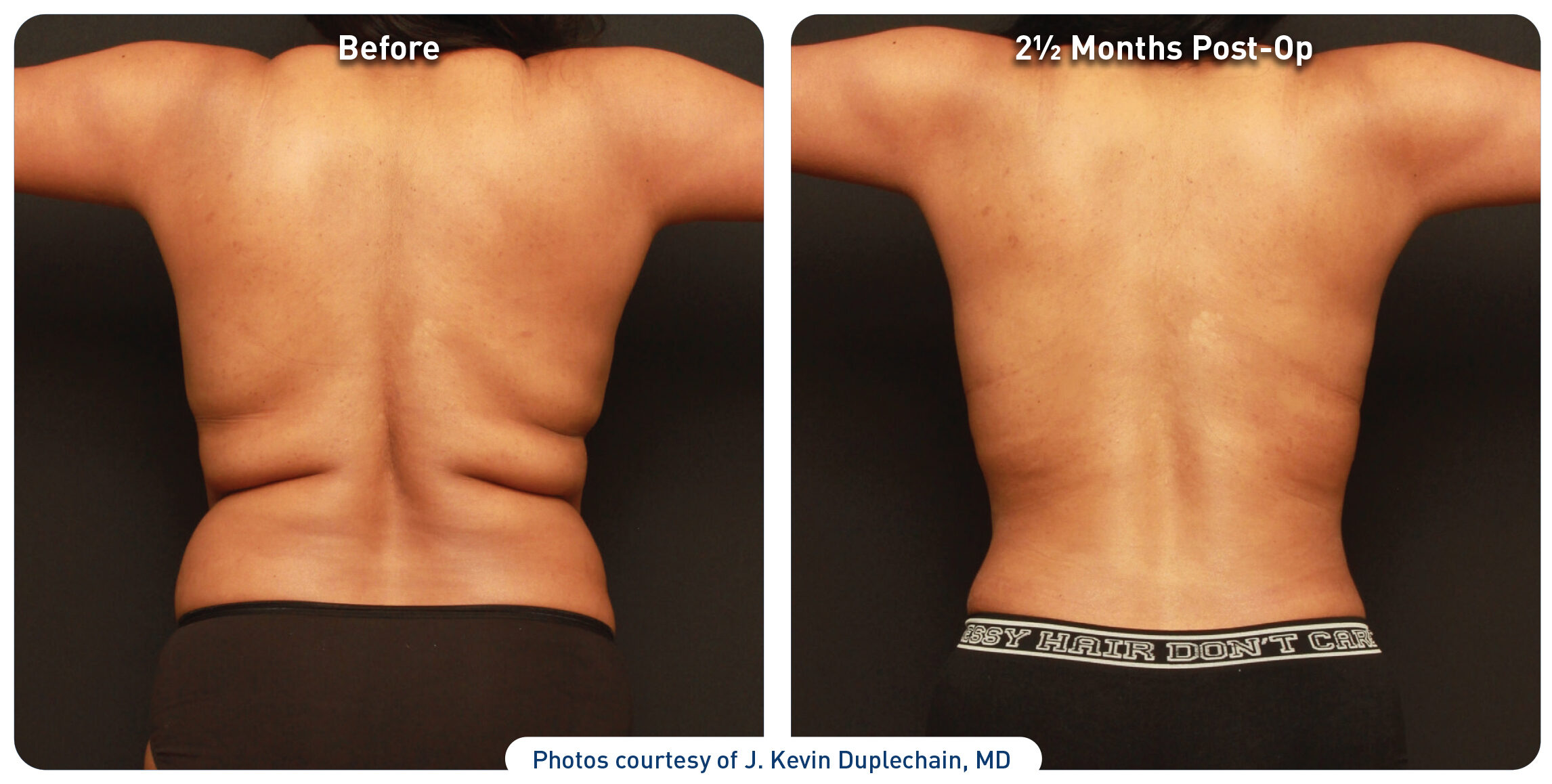 Renuvion Before After Back Axilla and Flanks Case1 photos 300dpi