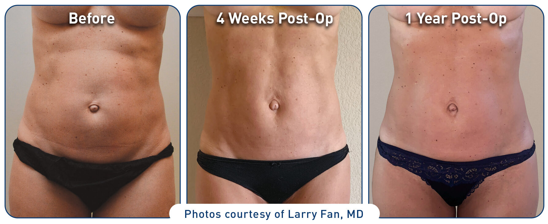 Renuvion Before After Abdominal Case3 photos 062320 front 300dpi