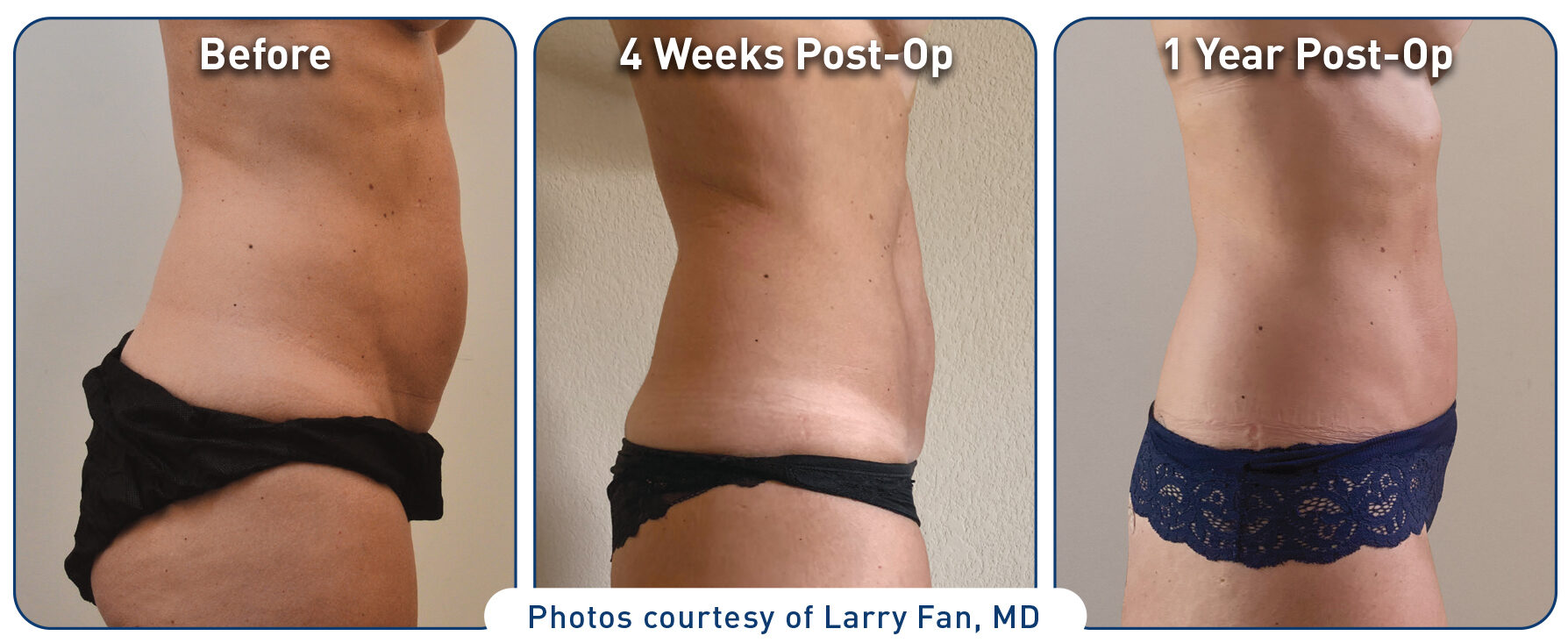 Renuvion Before After Abdominal Case3 photos 062320 side 300dpi