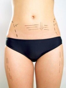 Tummy Tuck