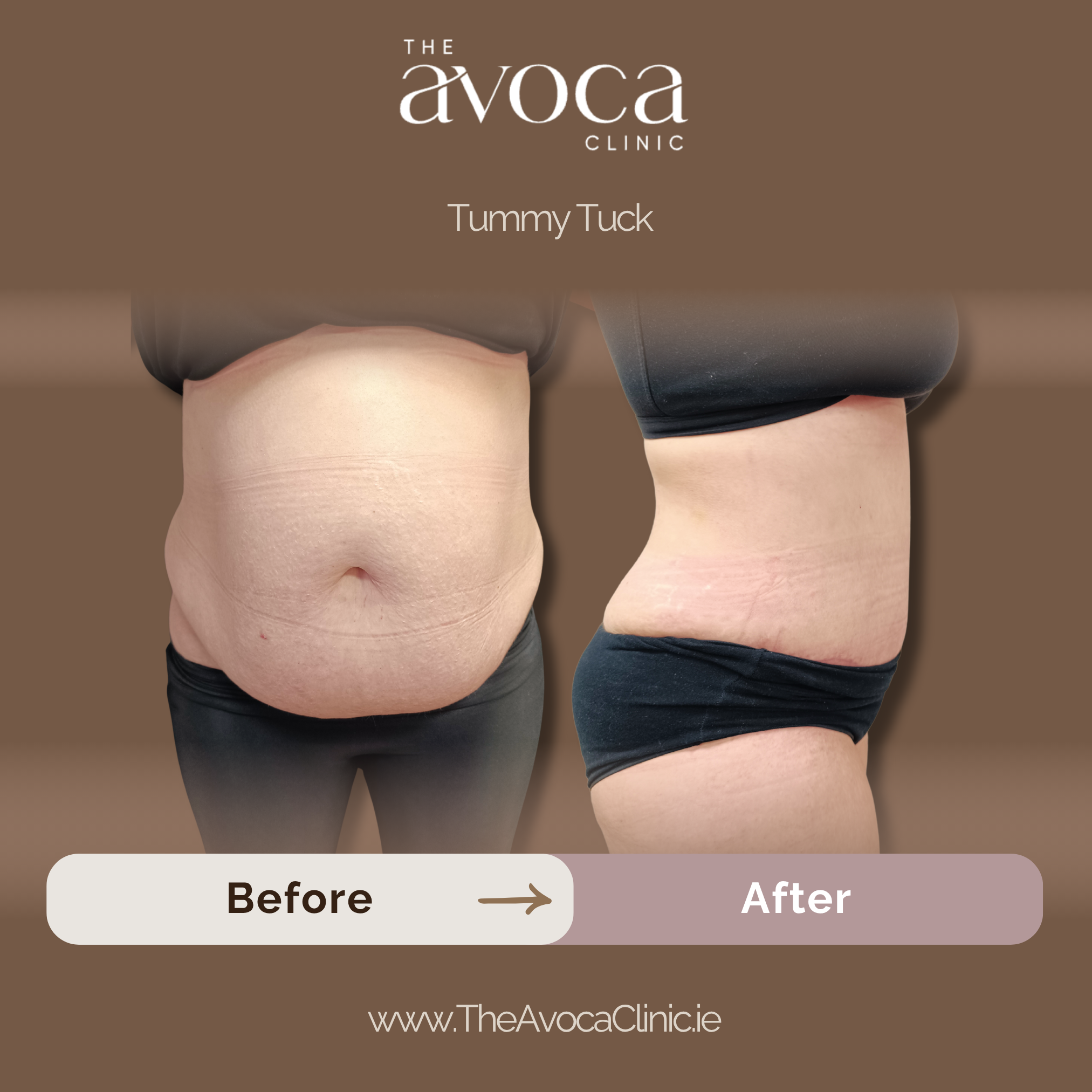 Tummy Tuck2 1