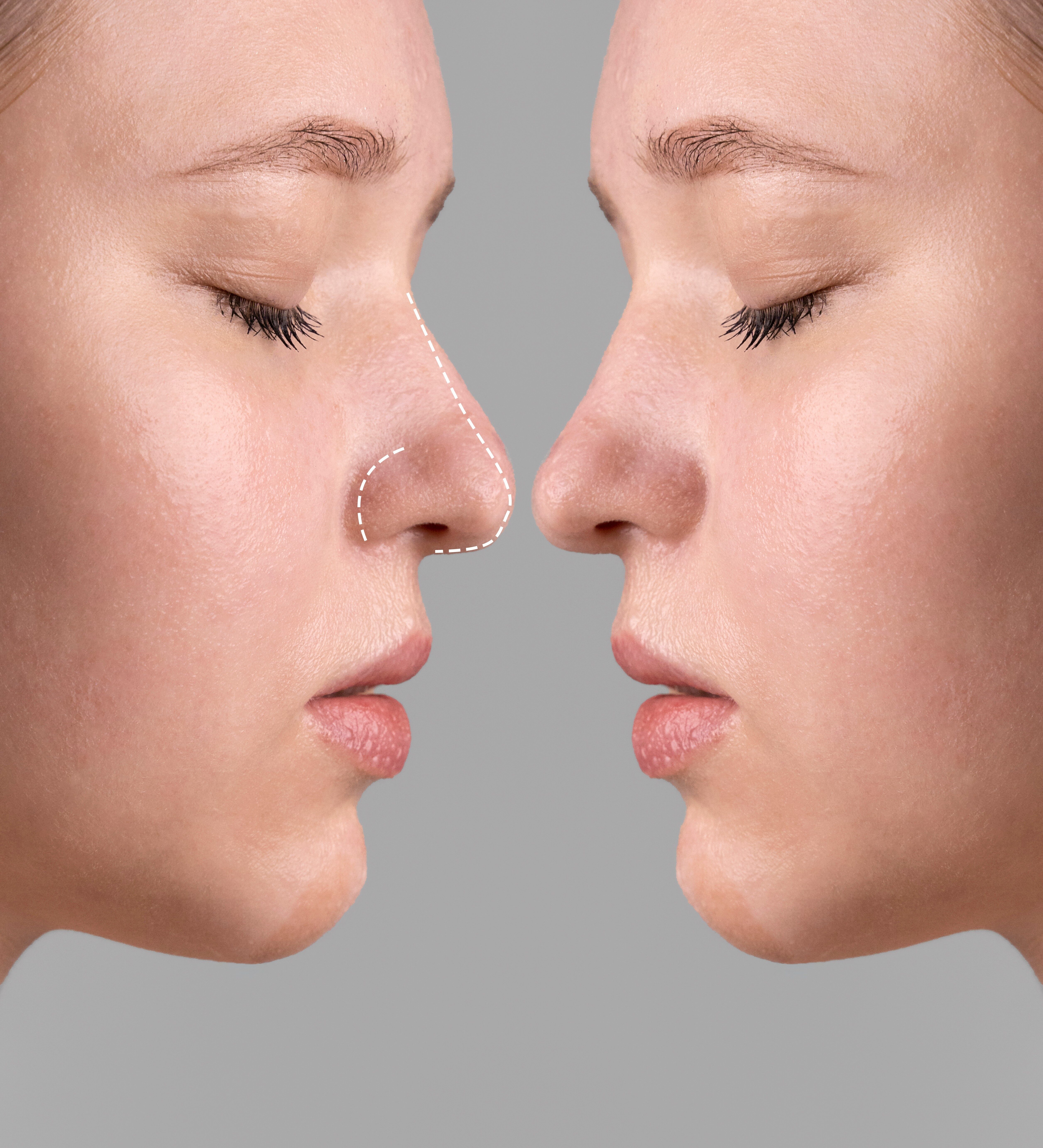 Rhinoplasty surgery concept with woman model 2