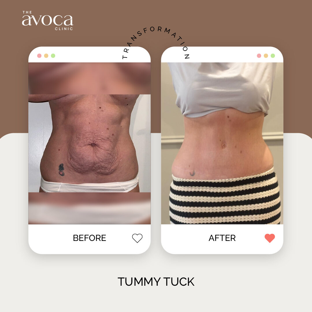 Tummy tuck transformation
